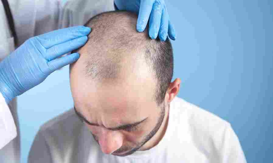 Hair Transplant London – Permanent Solution for Hair Loss