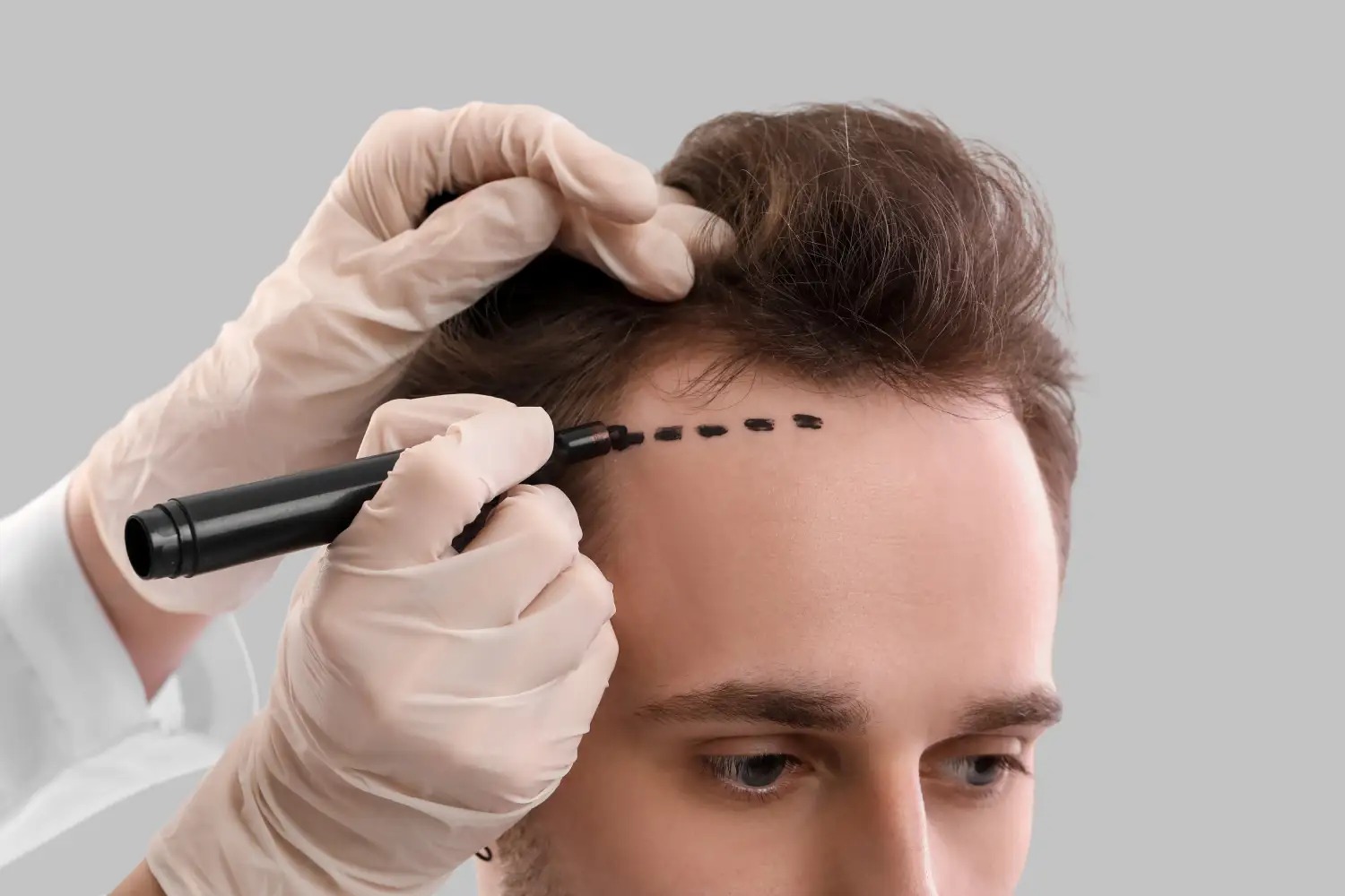 Hair Transplant Istanbul: How to Prepare for Your Procedure