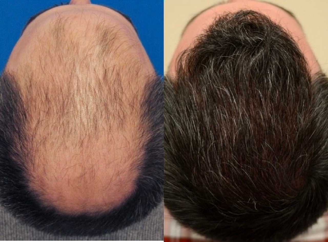 Affordable Hair Transplant London Options with World-Class Results